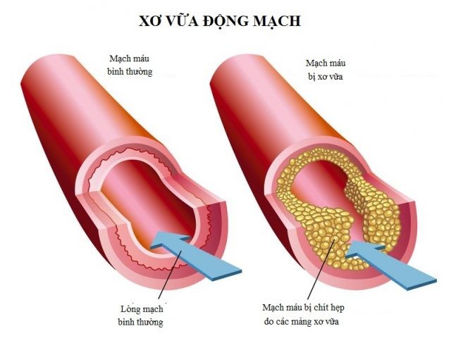 Xơ vữa động mạch: nguyên nhân, triệu chứng và cách điều trị - Family Hospital